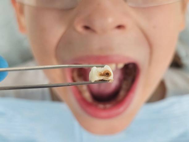 Best Emergency Wisdom Tooth Extraction in Edmond, OK